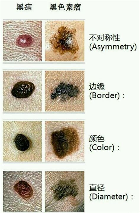 黑色的痣|你身上的痣会癌变吗？医生分析了100多颗黑痣，快来。